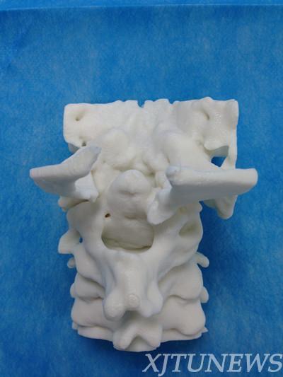 交大二附院完成全国首例颈椎3D打印钢板经口