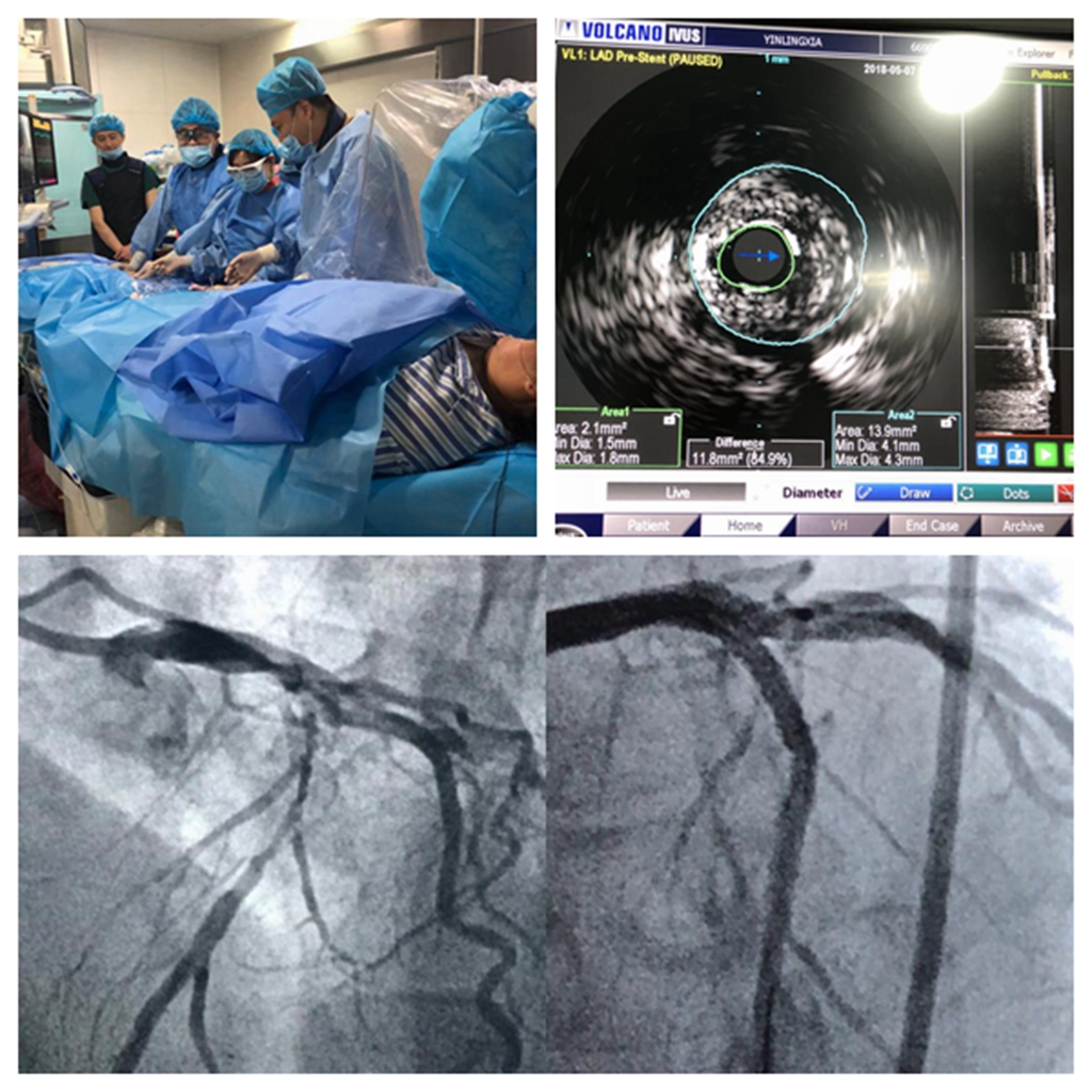 冠脉造影 | 给心脏血管拍个照片，原来它长这样_广州市荔湾区人民医院