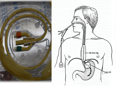 气管食管瘘图片 分型图片
